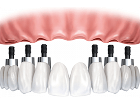 implantes dentales